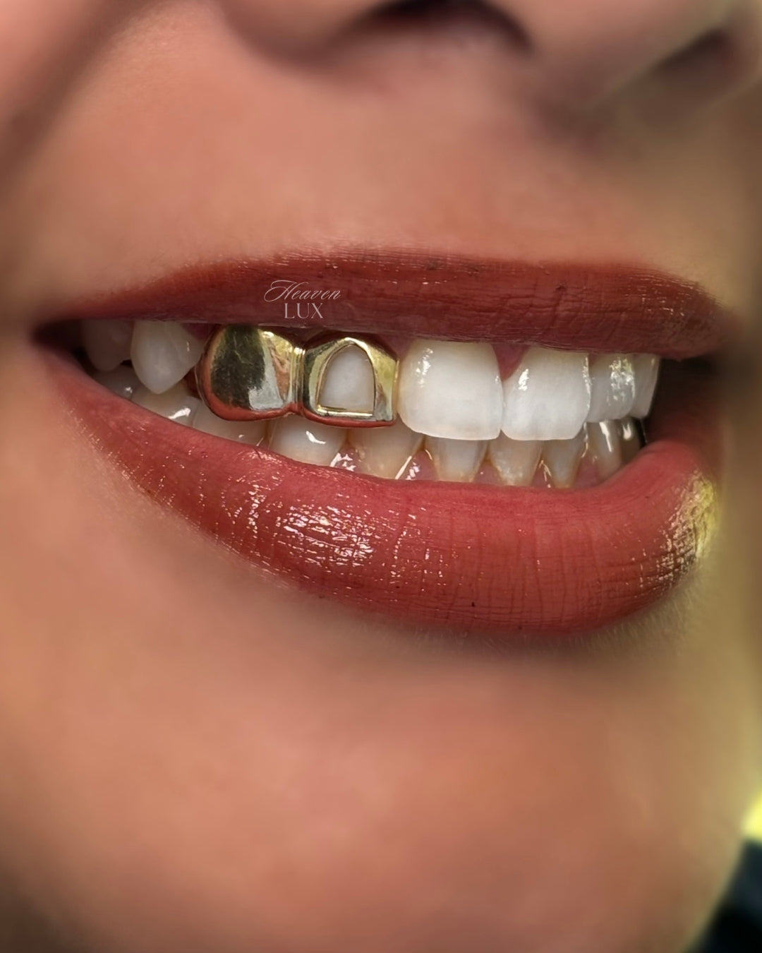 Glow for the Gold~ Teeth Whitening + Grillz Impression/Consultation (silver, gold, etc.)