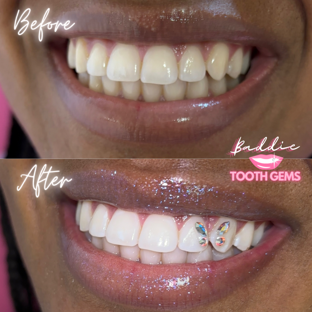 Professional Teeth Whitening System