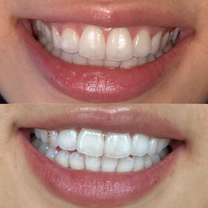 Cosmetic Teeth Whitening Reservation DEPOSIT*