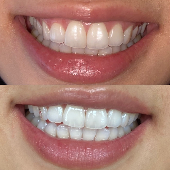 2 Client Teeth Whitening Reservation DEPOSIT*