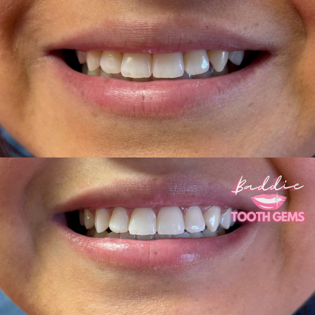 Teeth Whitening Gel Wholesale for Professionals