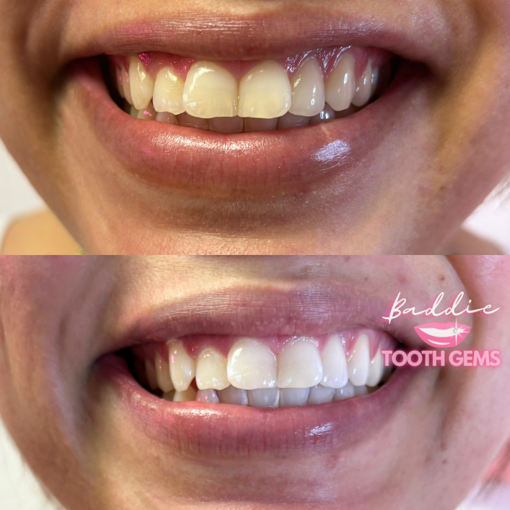 Professional Teeth Whitening System